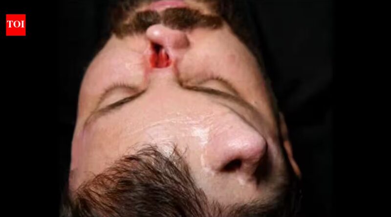 Iraqi surgeon grows nose on patient's forehead in rare reconstruction surgery to correct facial damage in high-voltage electrical accident